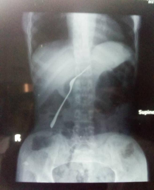 Figure 1: Cutlery (fork) in plane X-ray Erect